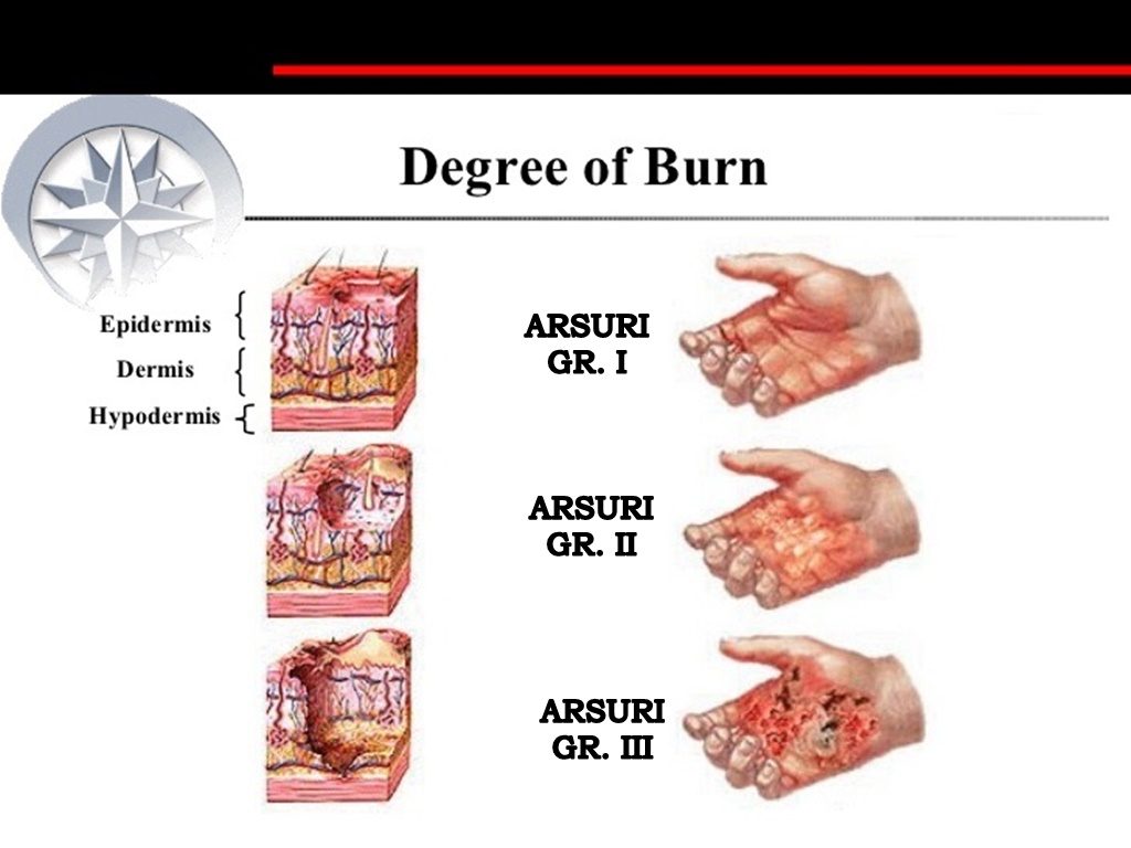 complexul de arsuri de grăsime