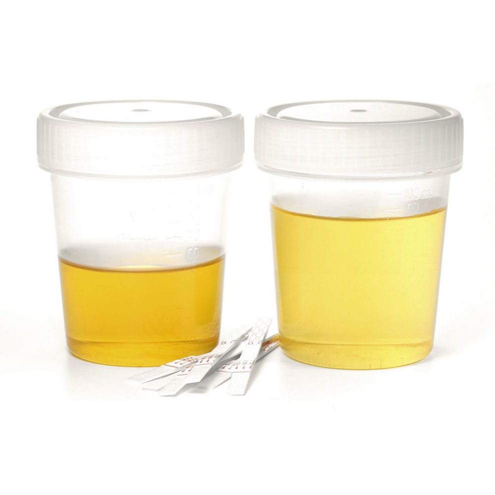 cum să colectezi urina cu prostatita semne ascunse ale prostatitei