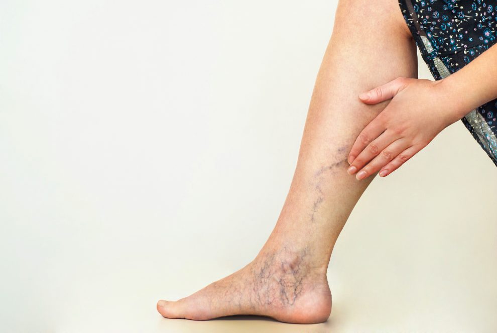 piele întunecată pe picioare în varicoză